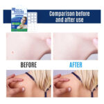 Skin Tag Remover Patches 44 PCs by Royal Prestige - Image 2