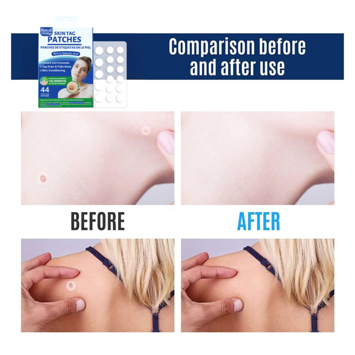 Skin Tag Remover Patches 44 PCs by Royal Prestige - Image 2