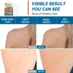 Skin Tag Remover Patches, 66 Patches by Royal Prestige - Image 5