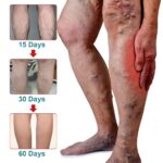Varicose Vein Care Patch (8 Boxes) – Herbal Leg Support Patch for Circulation & Vein Comfort - Image 15